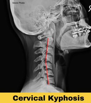 Cervical Kyphosis: Uncover Non-Surgical Treatments & Causes