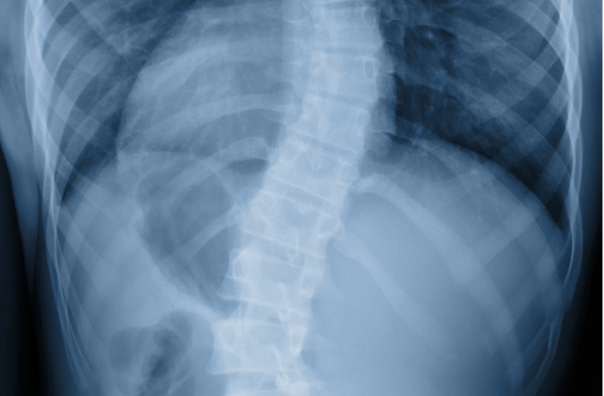 Idiopathic Adolescent Scoliosis: Uncover the Mystery Behind The Curve!