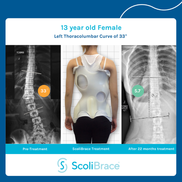 ScoliBrace: A 3D Corrective Scoliosis Brace for Children and Adults